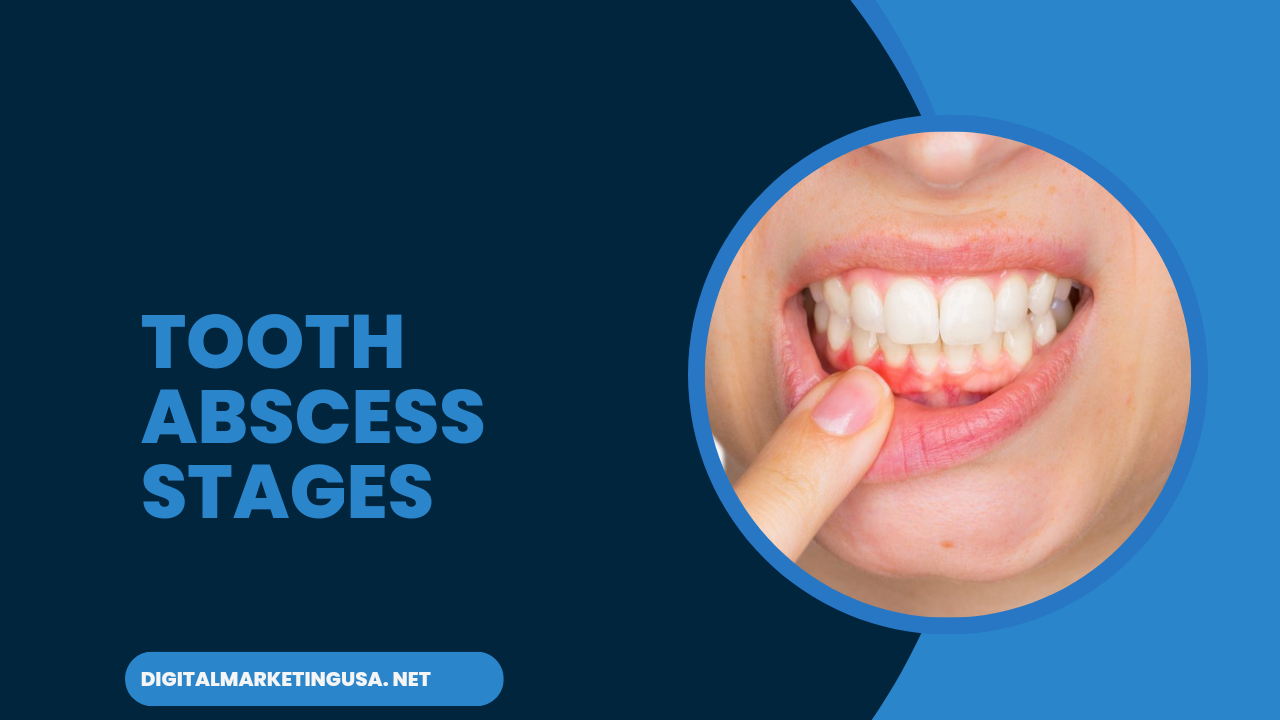 Tooth abscess stages