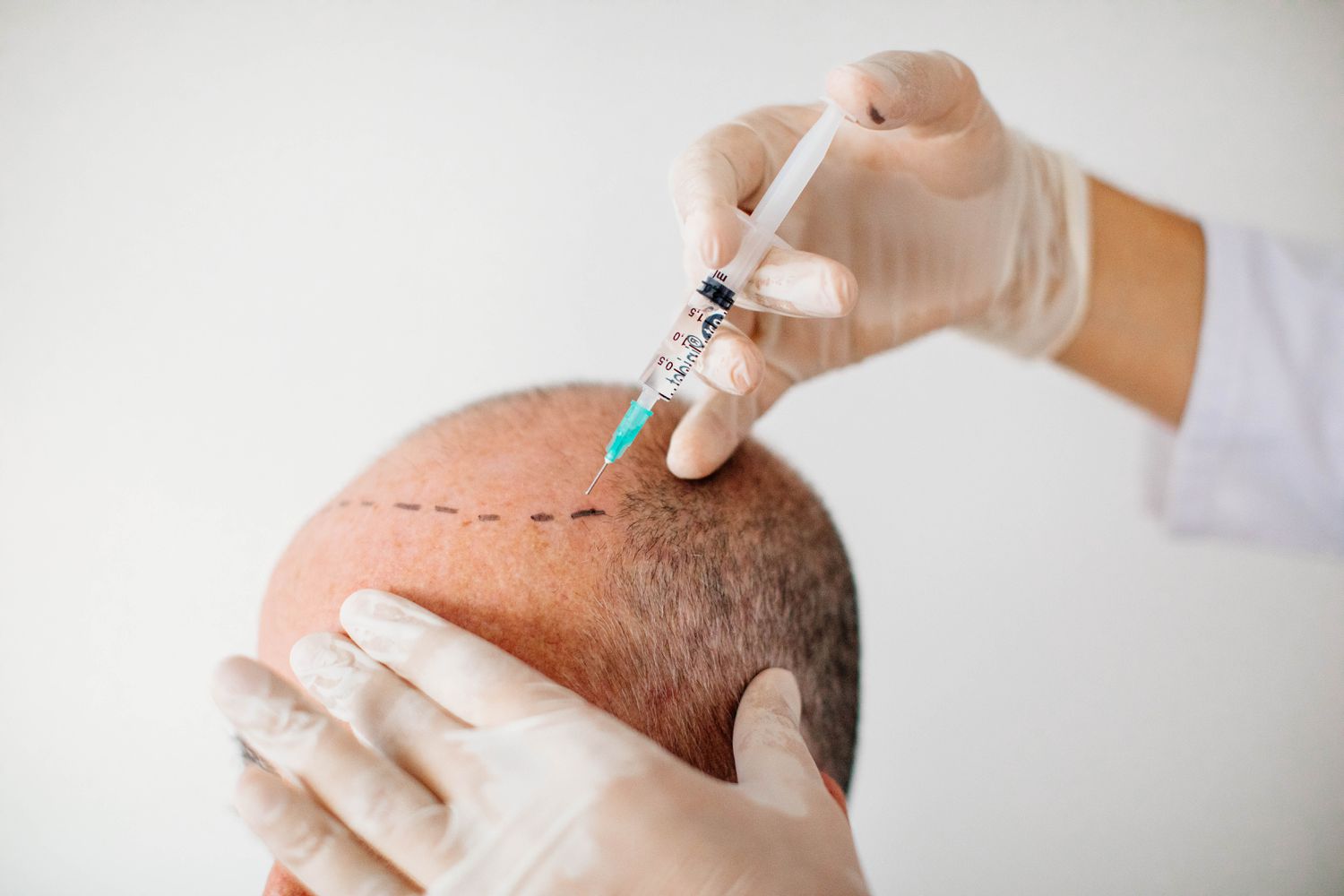 Hair Transplant in Vancouver Cost