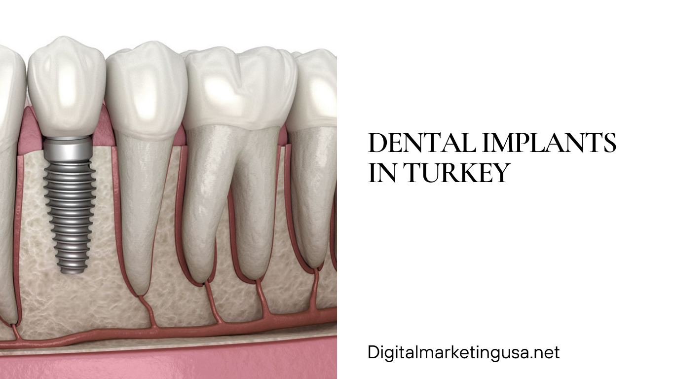 Dental implants in turkey