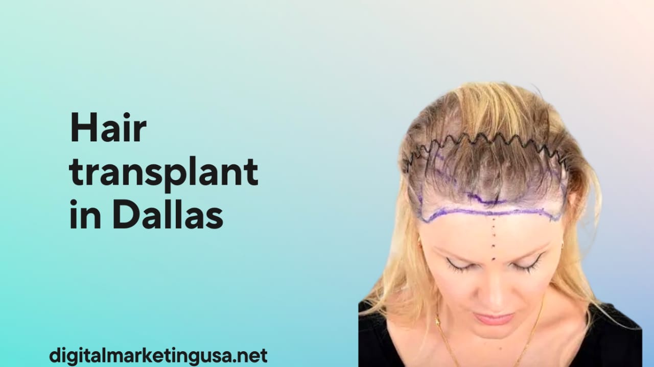 Hair Transplant in Dallas