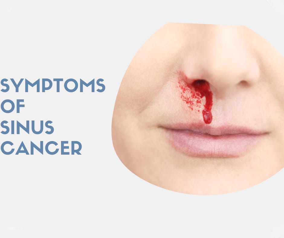 Symptoms of sinus cancer